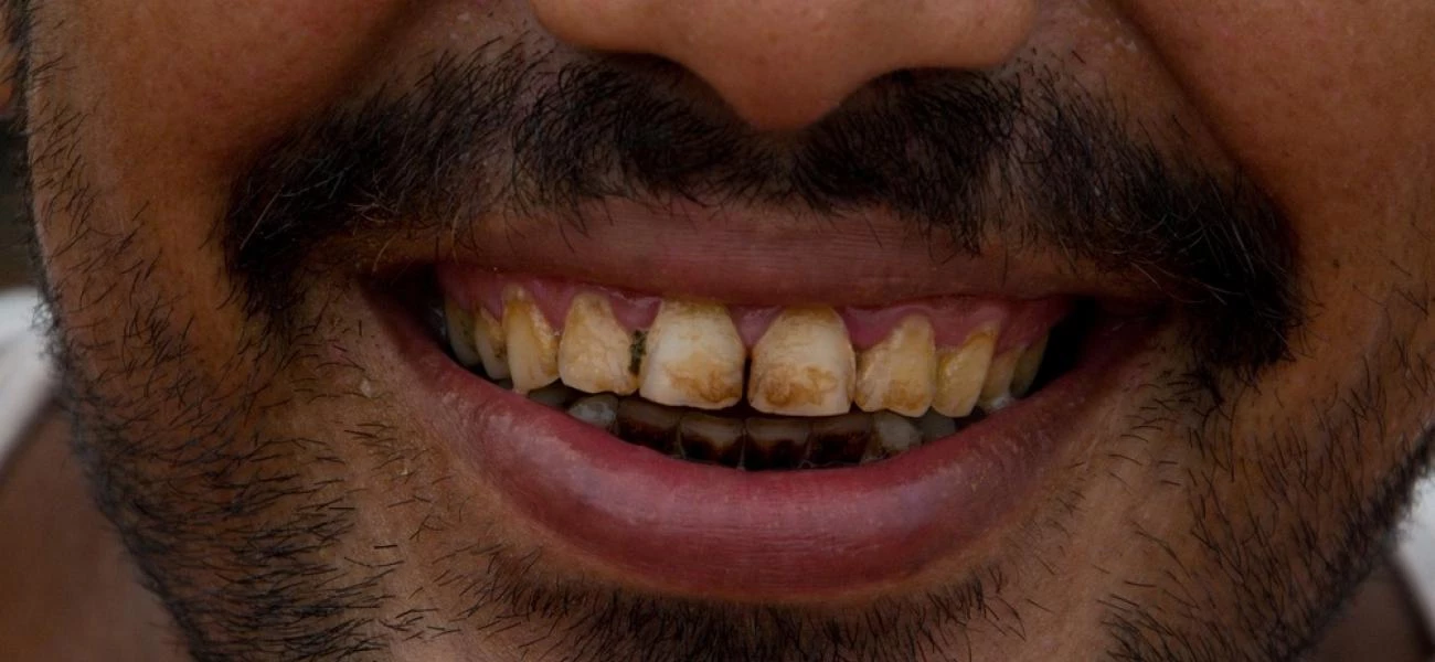 Červené zuby jsou typické pro milovníky betelu. 